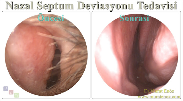 Nazal septum deviasyonu tedavisi - Deviasyon ameliyatı- Septoplasti ameliyatı