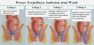 Harga Obat Antihemoroid AmbeJoss Obat Wasir