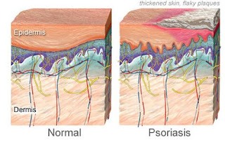 5 Alternative Therapies for ‪Psoriatic‬ Arthritis