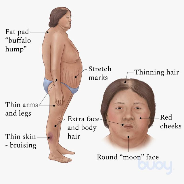 Cushing’s syndrome
