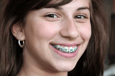 Thực hiện niềng răng khểnh như thế nào tại nha khoa? 1