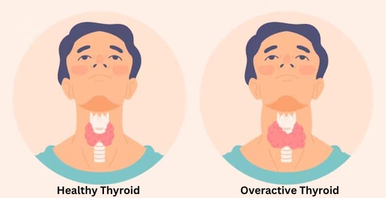 థైరాయిడ్ వ్యాధి అంటే ఏమిటి? | What is thyroid disease in Telugu