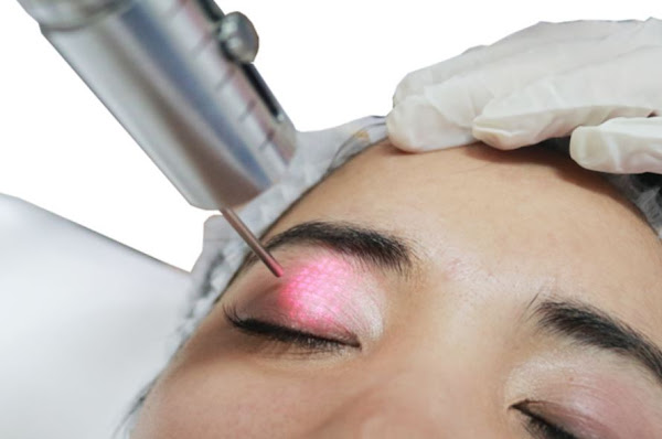 Eyes Rejuvenation Laser