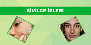 Sivilce İzleri