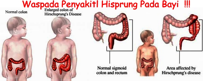 Obat Tradisional Hisprung Pada Bayi