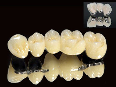 Phân tích các ưu điểm của bọc răng sứ titan-2