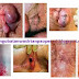 Obat Herbal Wasir Ambeven Tanpa Operasi thumbnail