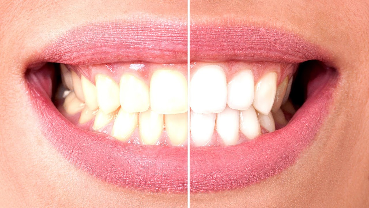 What Over The Counter Teeth Whitener Works Best