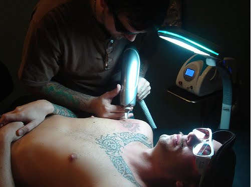 wrecking ball tattoo removal