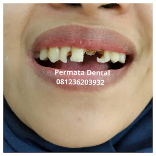 gambar foto contoh sebelum dan sesudah veneer gigi kelinci buatan manis cantik bali jember banyuwangi murah berkualitas di PERMATA DENTAL gambar gigi rusak yang di veneer gigi yang tidak rapi gigi renggang gigi patah cuil rompal pendek karies hitam kuning