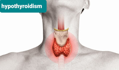 خمول الغدة الدرقية hypothyroidism