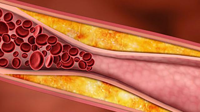 Penanganan Kolesterol dengan Konsep Karnus