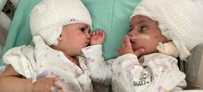 Twins conjoined at head isolated after uncommon medical procedure in Israel.