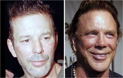 mickey rourke before plastic surgery