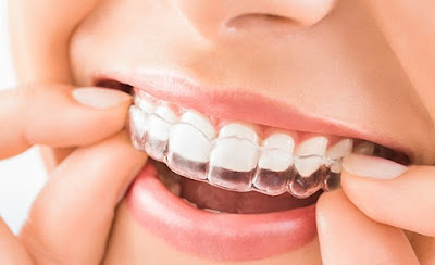 phuong-phap-nieng-rang-invisalign