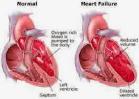 Decreased Cardiac Output - Nursing Care Plan for Heart Failure