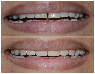 Porcelain Veneers - Smile Design