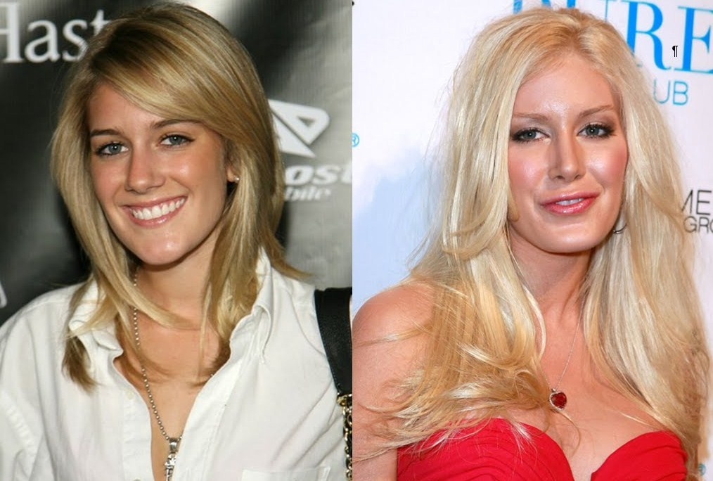 heidi montag before and after all surgery. Heidi Montag Before And After