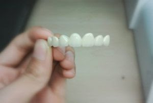 Răng sứ cercon và răng sứ titan có tốt hay không ?