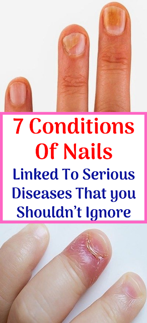 These 7 Conditions Of Nails Linked To Serious Diseases That you Shouldn’t Ignore