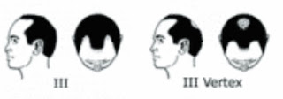 Male Pattern Baldness Noorwood Scale fightbald.blogspot