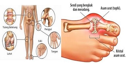 cara menurunkan asam urat dengan cepat