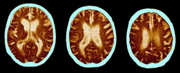 News,National,India,New Delhi,COVID-19,Health,Health & Fitness,Patient,Study,Top-Headlines, Brain impact of severe COVID akin to 20 years of ageing, UK study finds