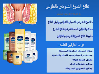 علاج الشرخ بالفازلين Treatment anal fissure  Vaseline