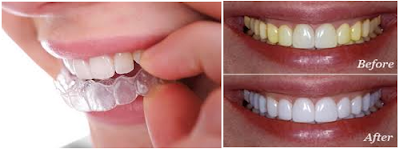 Cách tẩy trắng răng an toàn tại nha khoa