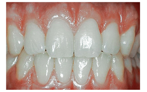 Periodontal Disease