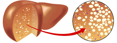 Gan bị nhiễm mỡ xuất hiện đốm mỡ trắng