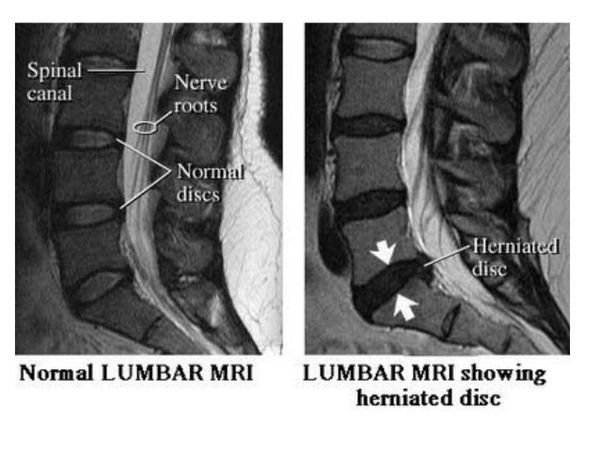 Cara Selamat Atasi Slipped Disc Tanpa Pain Killer Untuk 