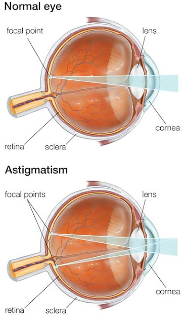 Normal Eye VS Astigmatism Eye