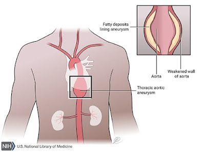 Singing Aorta - Marfan Syndrome and Dissection