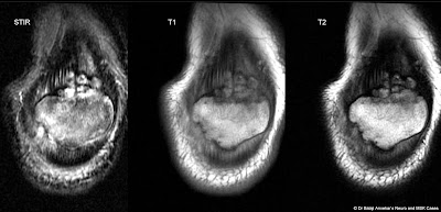 Osteochondrosis%2Bof%2BSuperior%2BPole%2