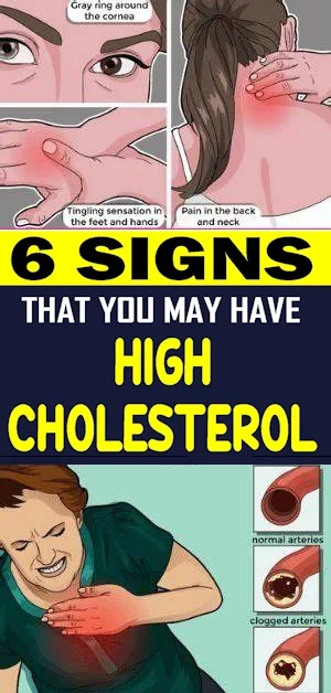 6 Signs That You May Have High Cholesterol