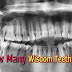 How Many Wisdom Teeth Do You Have? | Third Molars 