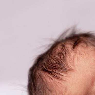 Scalp Hematoma in Baby & Adults Symptoms, Causes, Radiology, Treatment