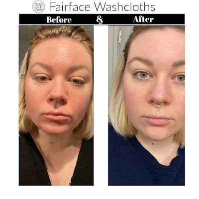 How Fairface Washcloths helped my Rosacea skin before and after pic