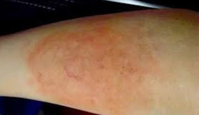 Natural Ways To Treat And Removes Burn Scars