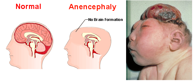 Pesona Mama Manja: Apa itu Spina Bifida dan Anencephaly?