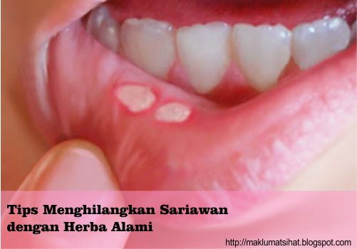 Tips Menghilangkan Sariawan dengan Herba Alami