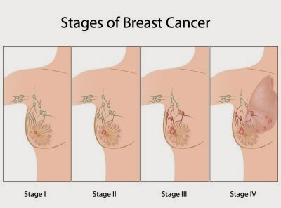breast cancer stages