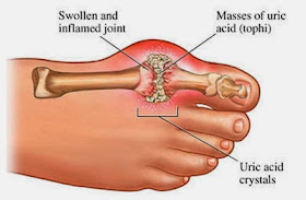 Penyakit asam urat adalah penyakit yang menyerang pada sistem sendi, paling sering menyerang sendi kaki dan tangan