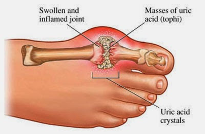 Penyakit asam urat adalah penyakit yang menyerang pada sistem sendi, paling sering menyerang sendi kaki dan tangan