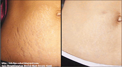 Cara Menghilangkan Stretch Mark