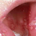 How to Treat Mouth Sores Caused by Chemotherapy