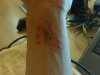 Mein Arm etwa 1 - 2 Wochen vor dem 03.10.2012.