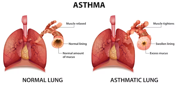 Asthma: Causes, Symptoms & Treatment