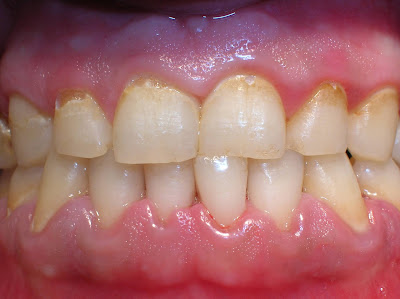 Placa dental adherida a los dientes